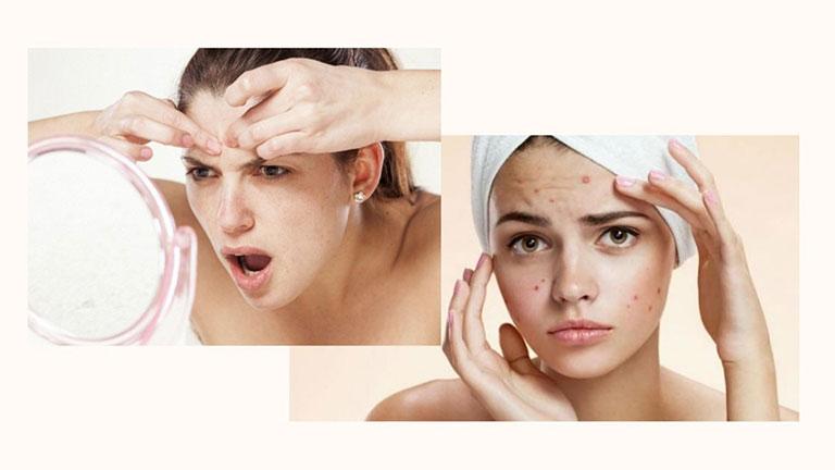 Có nên đi spa trị thâm mụn? Lời giải đáp từ chuyên gia da liễu